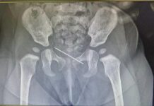 പിഞ്ചു കുഞ്ഞിൻ്റെ നാഭിയിൽ കുടുങ്ങിയ 3.5 സെന്റീമീറ്റര് സൂചി : പുറത്തെടുത്തു അല് ഹിലാല് ഹെല്ത്ത് കെയര്